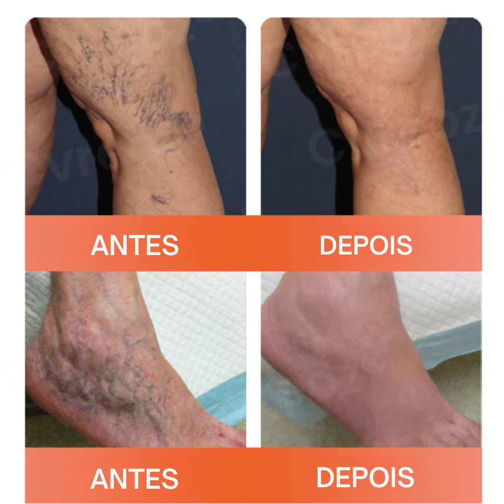 Microneedle Patch para varizes