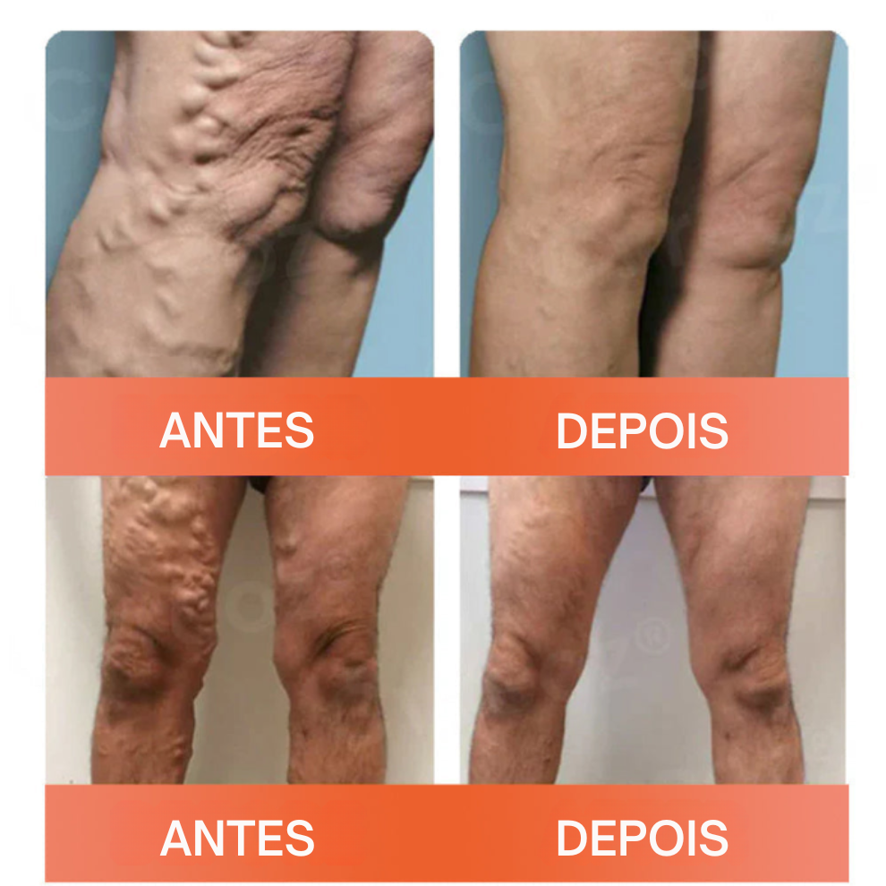 Microneedle Patch para varizes